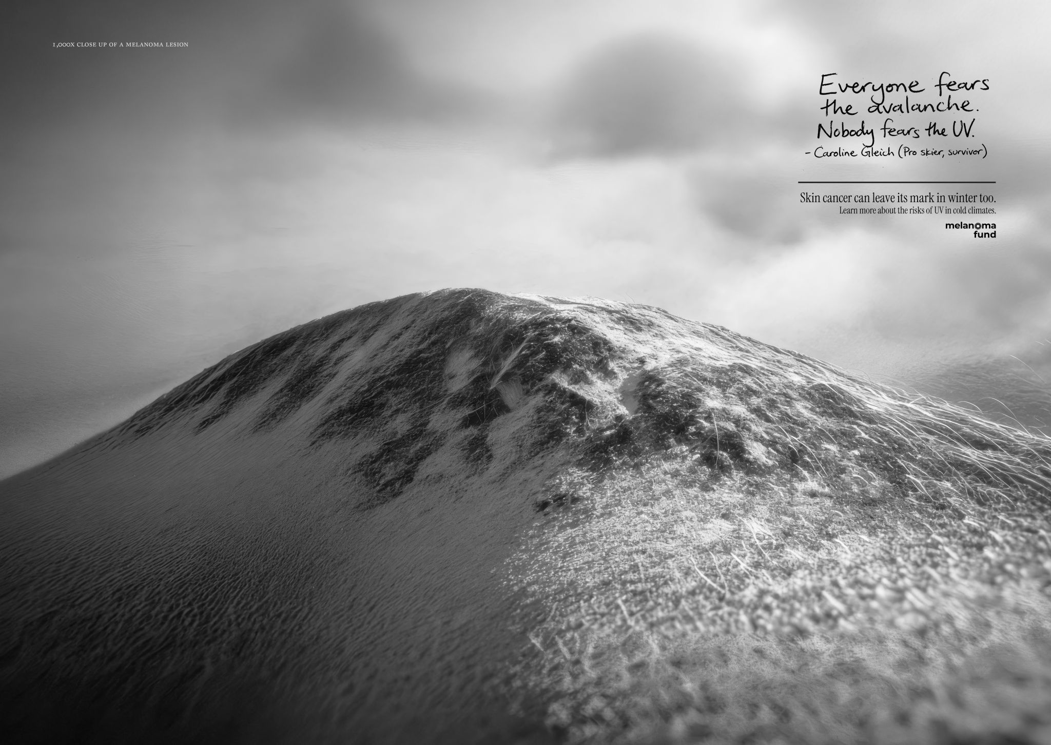 El cáncer de piel también deja huella en invierno